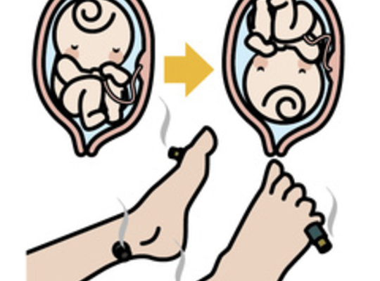 逆子のイラスト