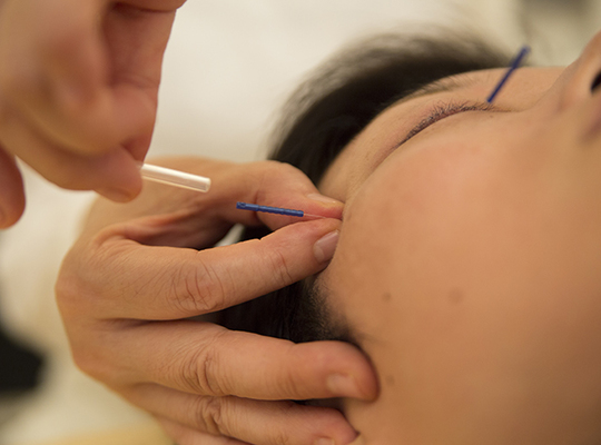 顔の鍼