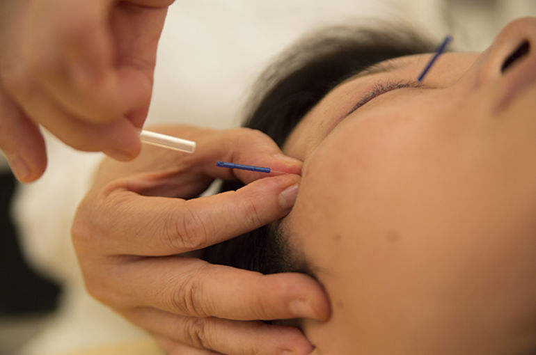 顔の鍼